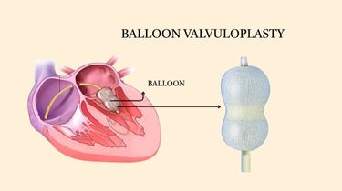 Balloon Valvuloplasty in India – Best Heart Valve Specialists & Treatment