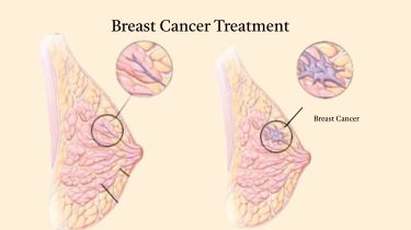 Breast Cancer Care Centres in India