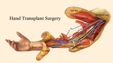 Hand Transplant Surgery