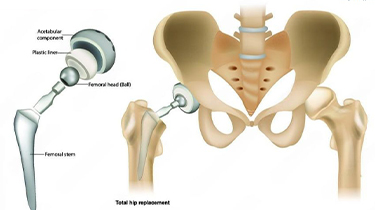 Orthopaedic & Joint Replacement Specialist in India