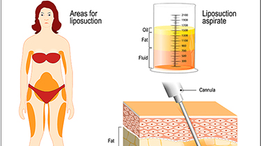 Liposuction Surgery Cost in Indi
