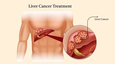 Liver Transplant Surgery Specialist