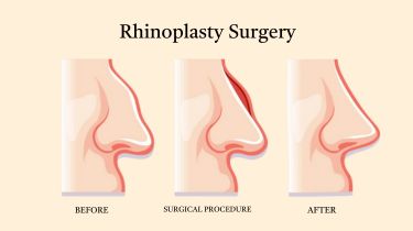 Rhinoplasty Surgery in India | Best Nose Reshaping & Cosmetic Surgery