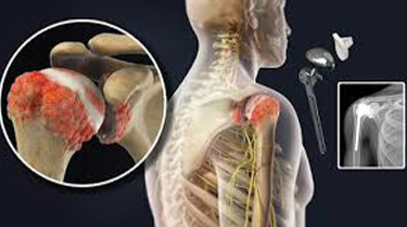 Orthopaedic & Joint Replacement Specialist in India , Expert Joint Care – Healthfly