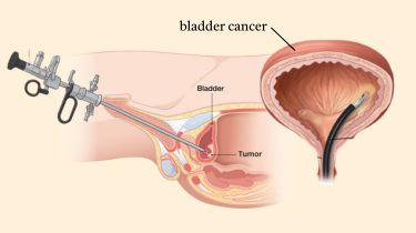 Bladder Cancer Treatment In India