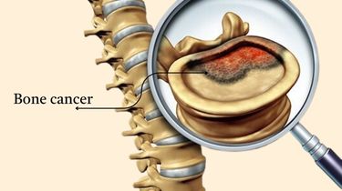 Bone Cancer Treatment Centres in India