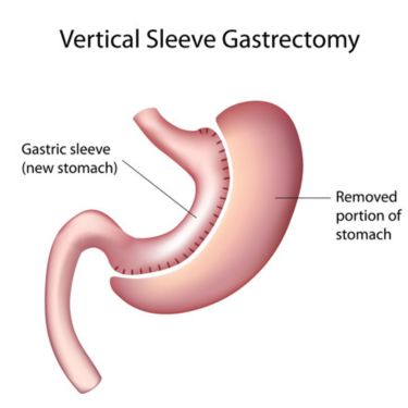 Sleeve Gastrectomy Surgery Cost in India