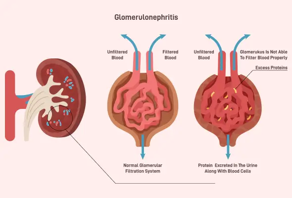 Glomerulonephritis: Causes, Symptoms & Kidney Care – Healthfly