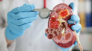 Kidney Care & Kidney Treatments in India Healthfly – Trusted Kidney Specialists