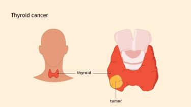 Thyroid Cancer Treatment in India – Best Oncologists & Advanced Care